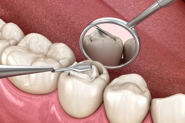 Signs Of A Worn Dental Filling
