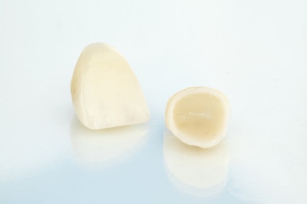 Dental Crowns Vs Bridges: Important Differences To Keep In Mind